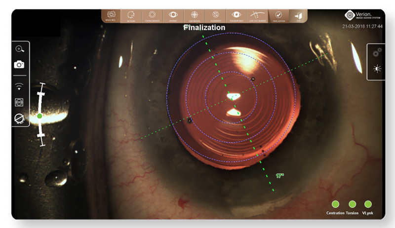 Final IOL position as captured by the Alcon Vision Planner