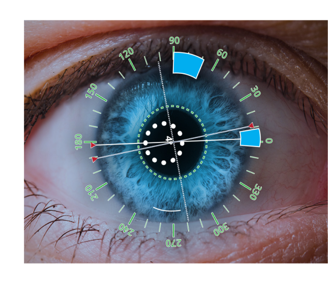 An image of an eye close up with a digital overlay showing angles and incision locations.