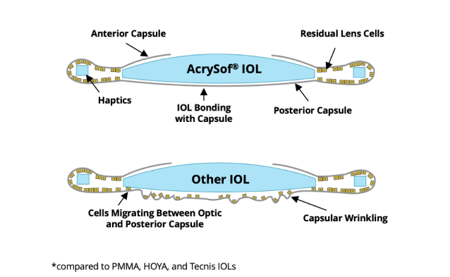 2 illustrations. The first one shows the AcrySof IOL bonded with the posterior capsul with not cell migration. The second illustration shows other IOLs with cells migrating between the optic and posterior capsule.