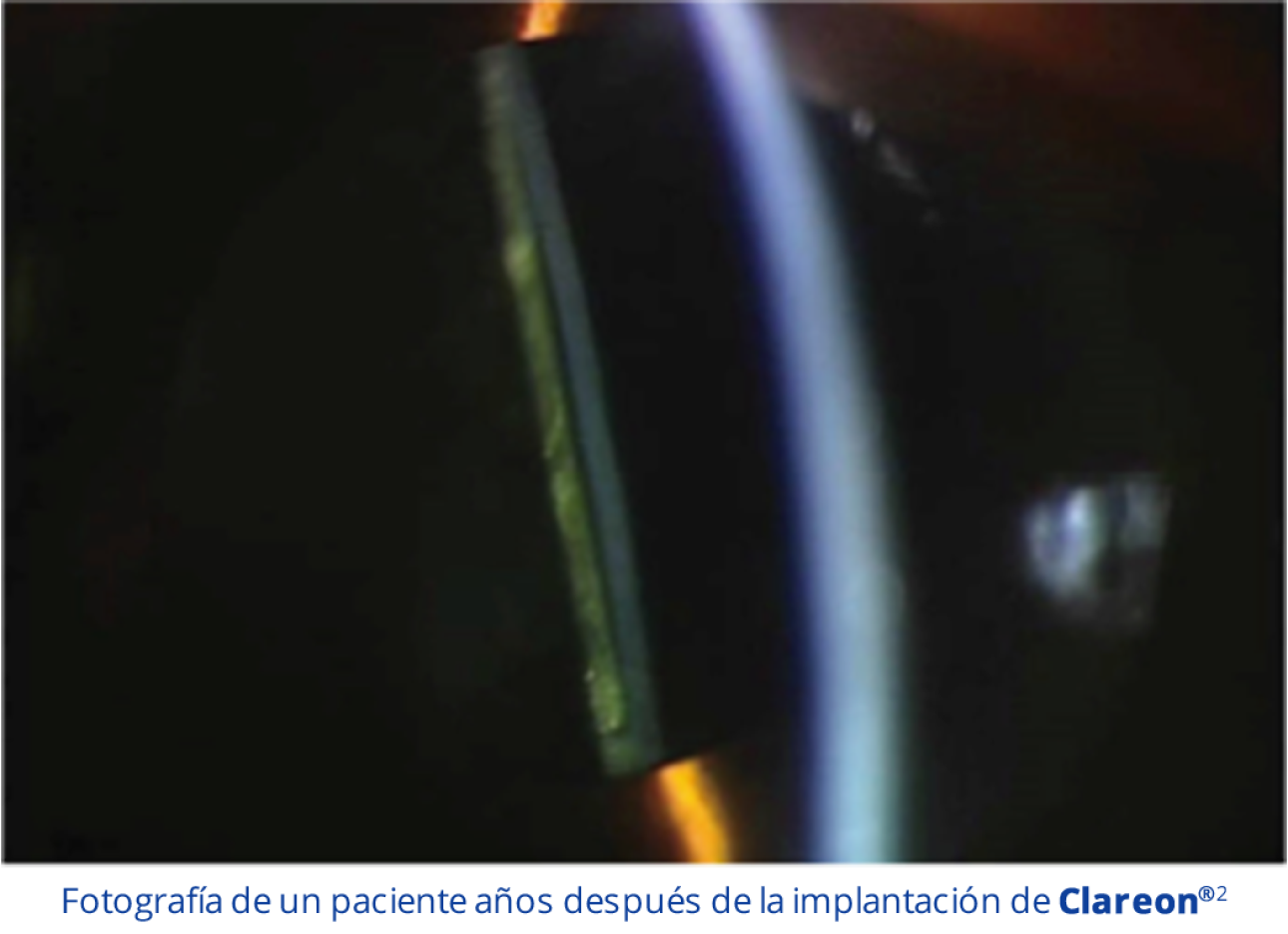 Esta imagen es una fotografía de un ojo de un paciente a los 9 años de la implantación de una LIO Clareon.