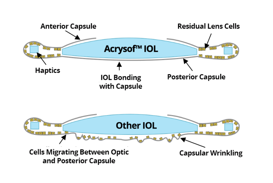 2 illustrations. The first one shows the AcrySof IOL bonded with the posterior capsul with not cell migration. The second illustration shows other IOLs with cells migrating between the optic and posterior capsule.