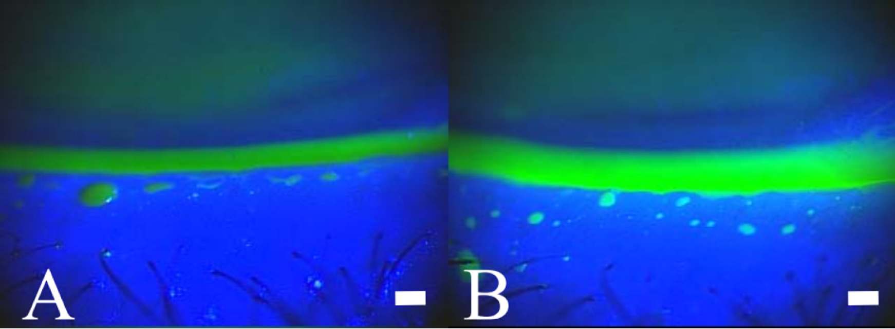 Estimation of meniscal tear height