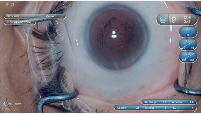 Primer plano de un ojo durante una operación, con instrumentos quirúrgicos que lo mantienen abierto. Hay una superposición digital en la imagen que muestra los parámetros y ajustes quirúrgicos.