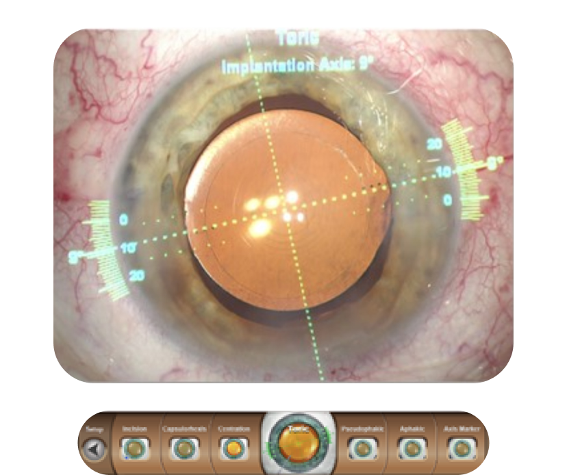 Primer plano de un ojo con superposición digital de VERION™ que muestra el eje tórico de implantación.