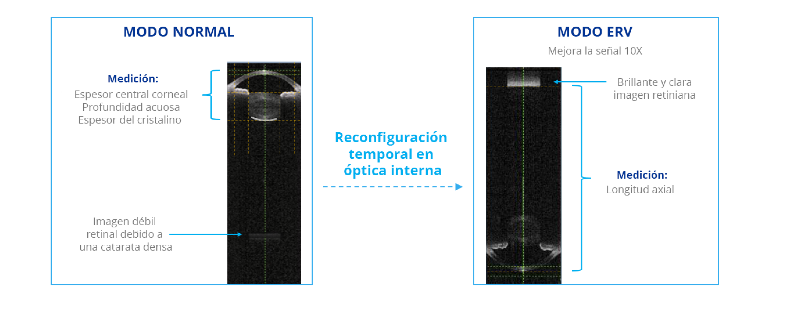 Comparación de imágenes de biometría capturadas por el biómetro de ARGOS en modo normal y en modo de visualización de retina mejorada (ERV). El modo ERV reconfigura la óptica interna para mejorar la señal en la retina 10 veces comparado con el modo normal.